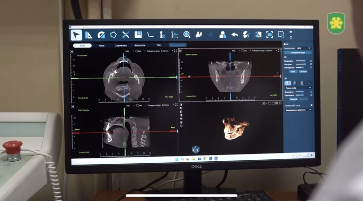 «Якісна медицина — здоровʼя громади»: нові послуги у стоматологічномувідділенні КДЦ в Бучі за підтримки Німеччини